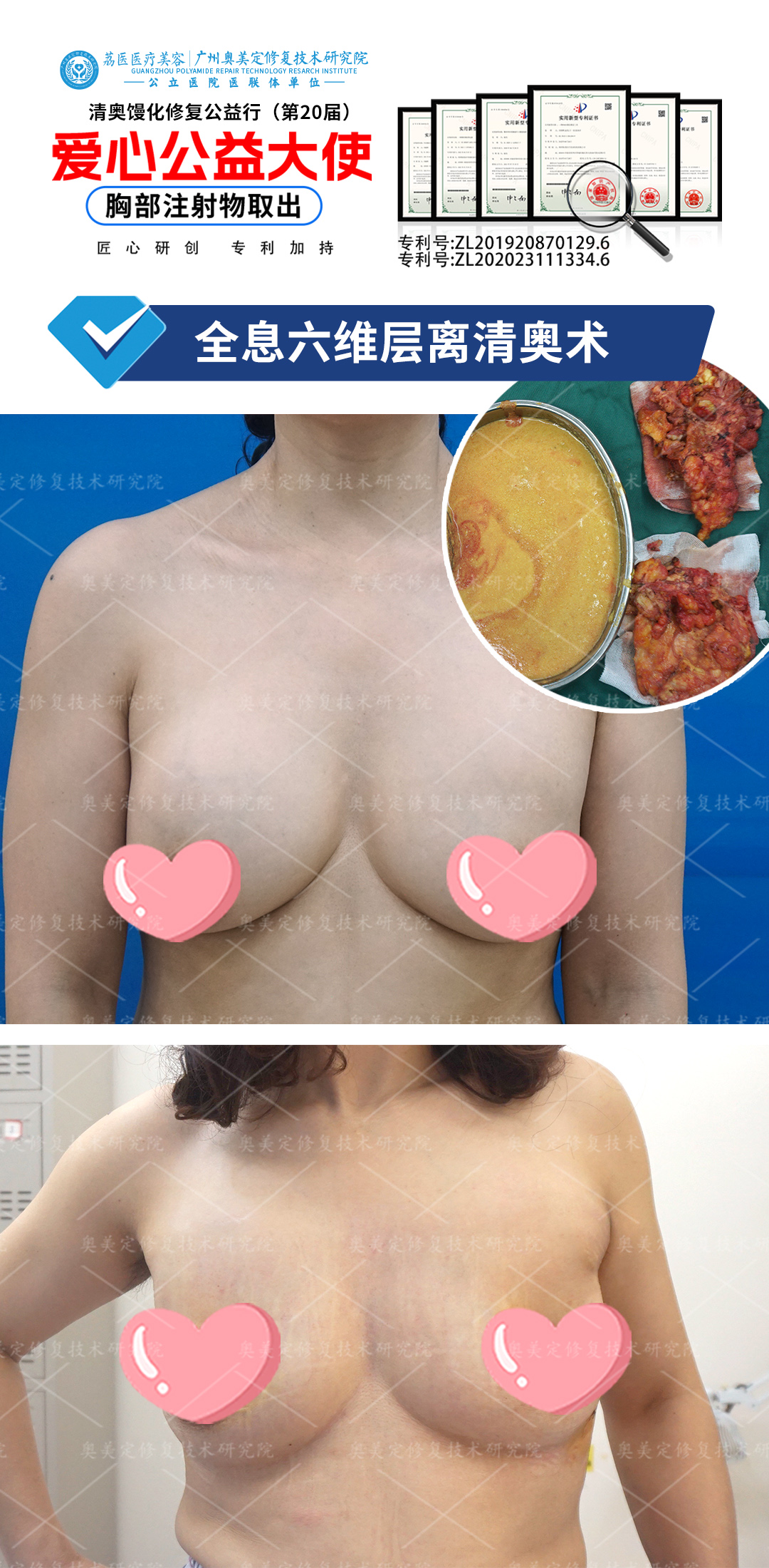 捷克水分子隆胸后要取出吗