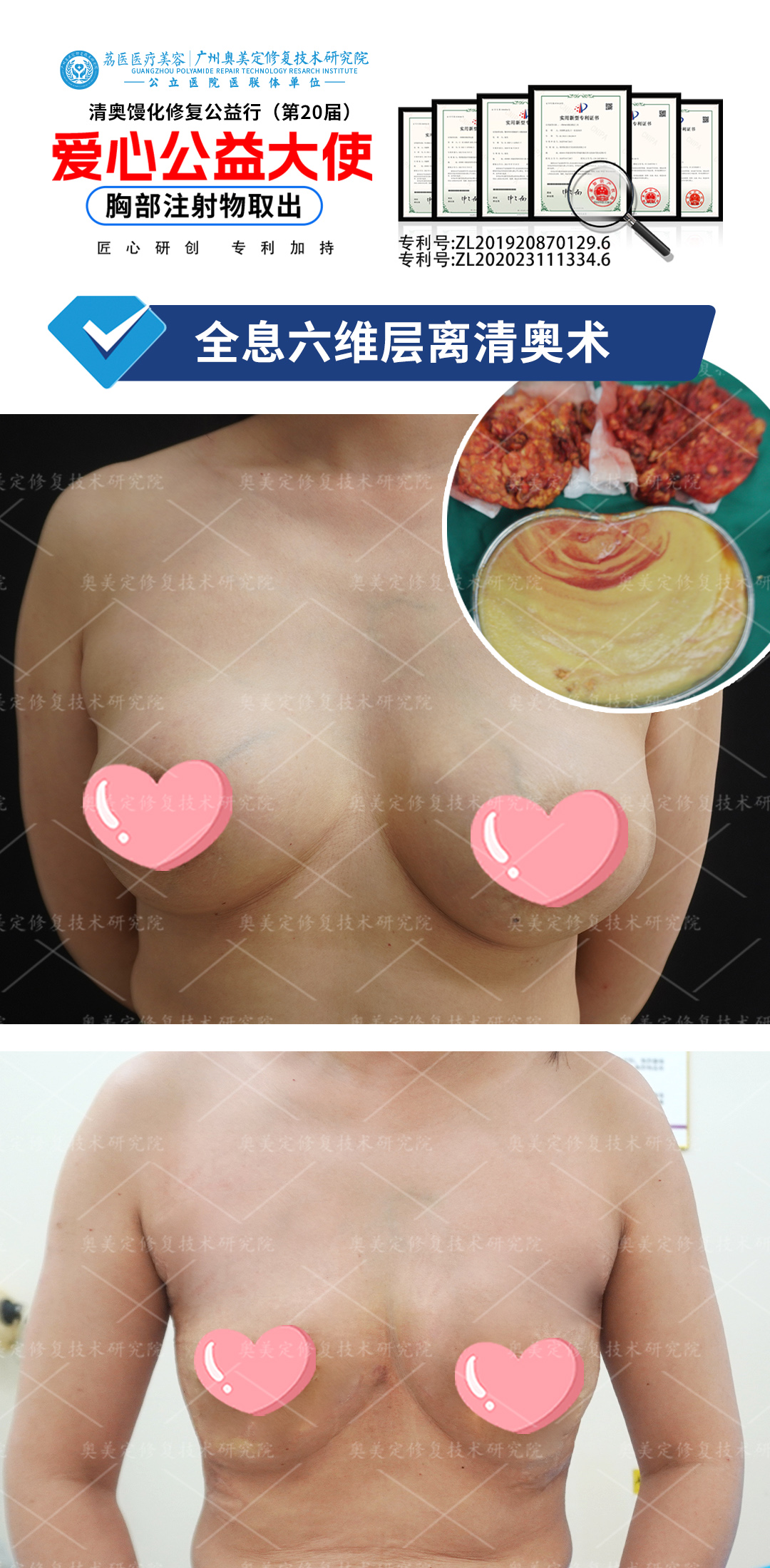 3年捷克水分子噩梦！女子胸部硬结胀痛，来院成功取出