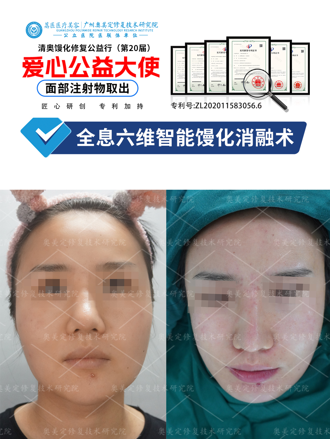 苹果肌打了生长因子后怎么取出修复