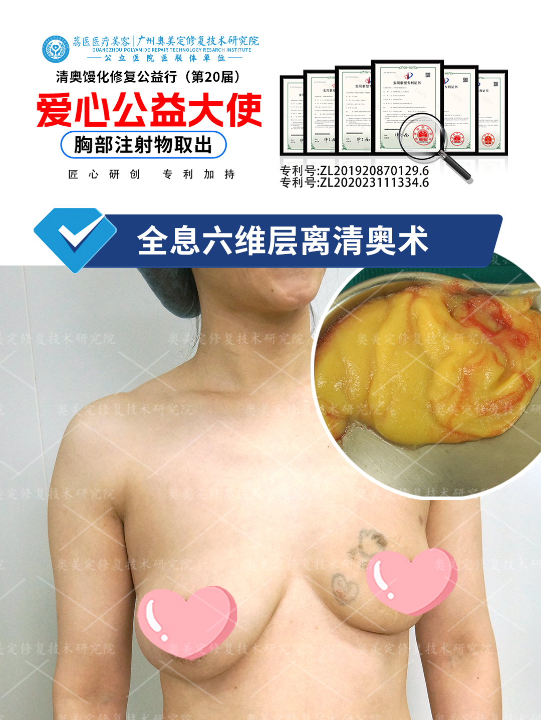 胸部注射了奥美定多年还能取出吗