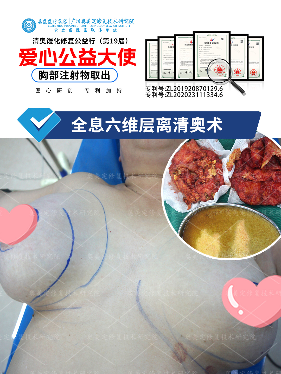 注射“奥美定隆胸”5年，胸部硬如石头