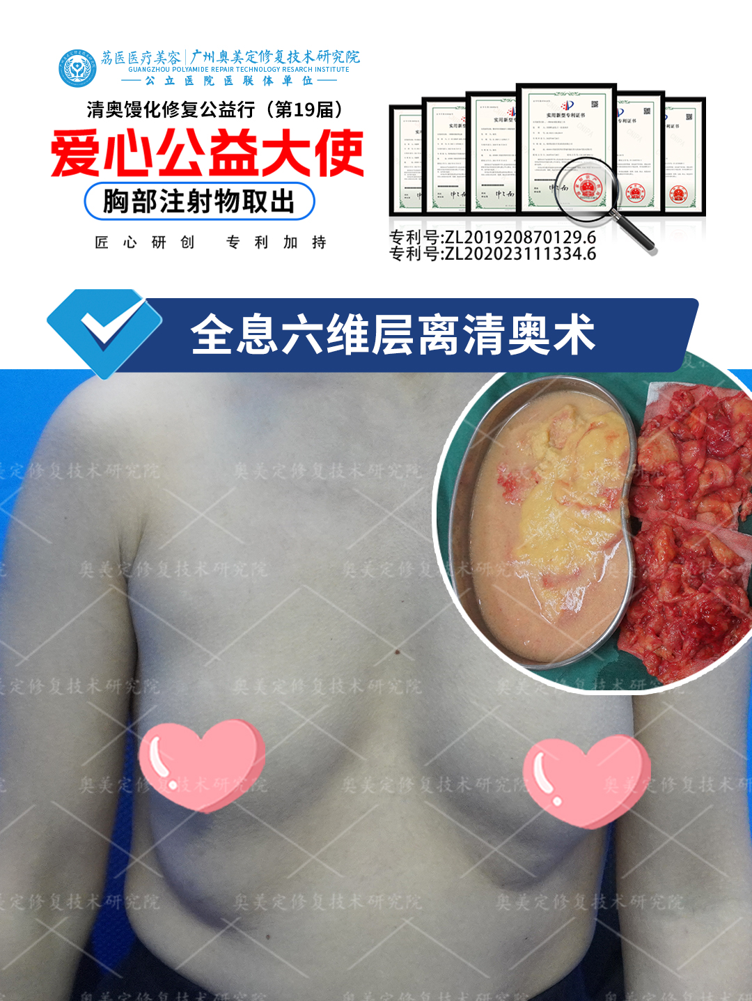 奥美定隆胸后出现胀痛变形，来院成功取出修复