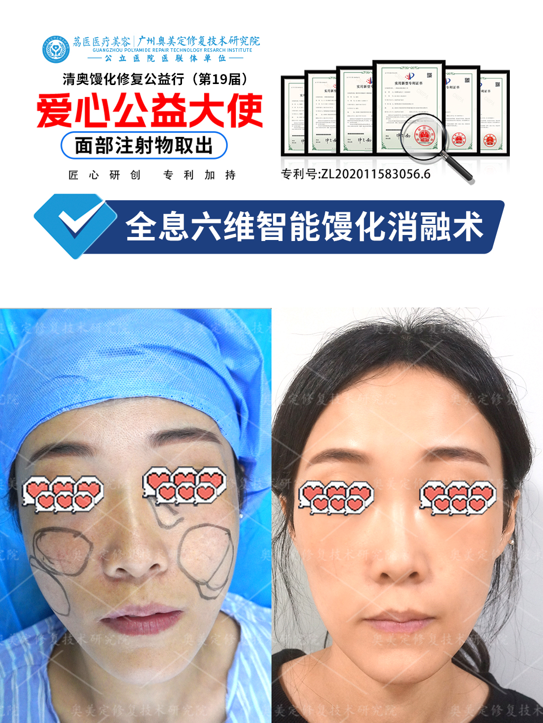 苹果肌填充失败：硬块、下垂、僵硬，还能修复吗？