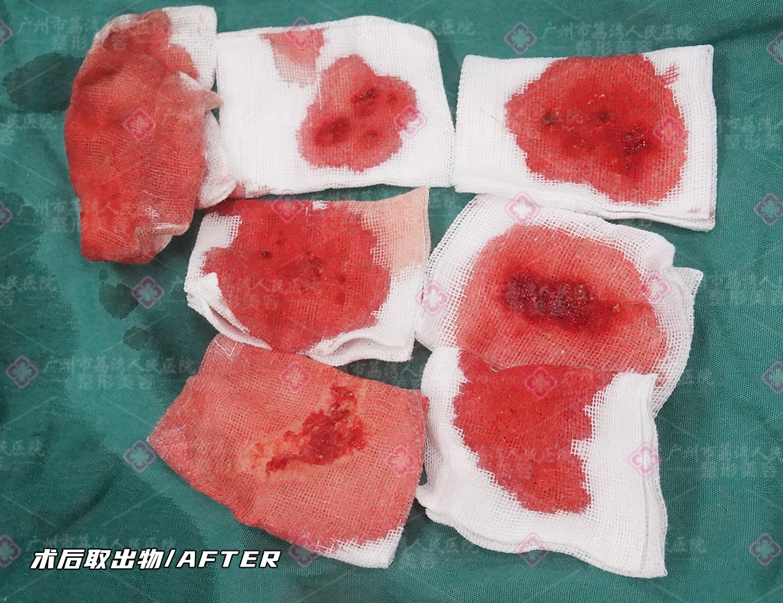 捷克水分子丰体针什么技术可以取出