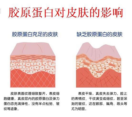 胶原蛋白和玻尿酸哪个填充效果好
