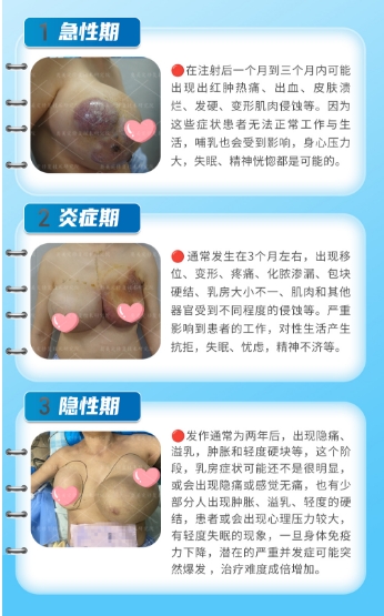 奥美定与玻尿酸：你必须知道的微整形真相