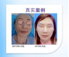 面部馒化要怎么修复