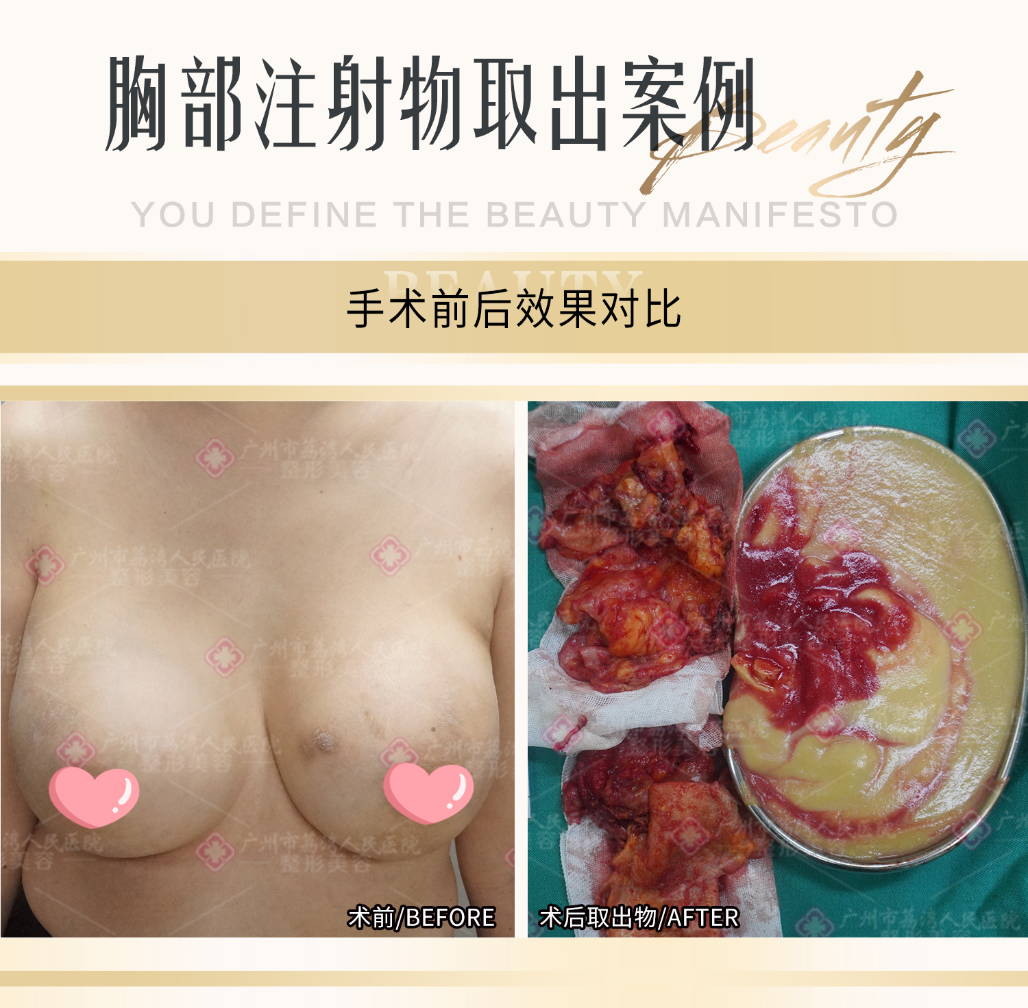 奥美定隆胸